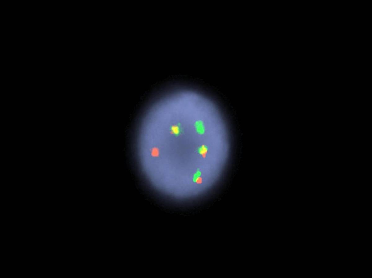 FISH with BCR/ABL dual fusion probe showing atypical pattern with three fusion signals